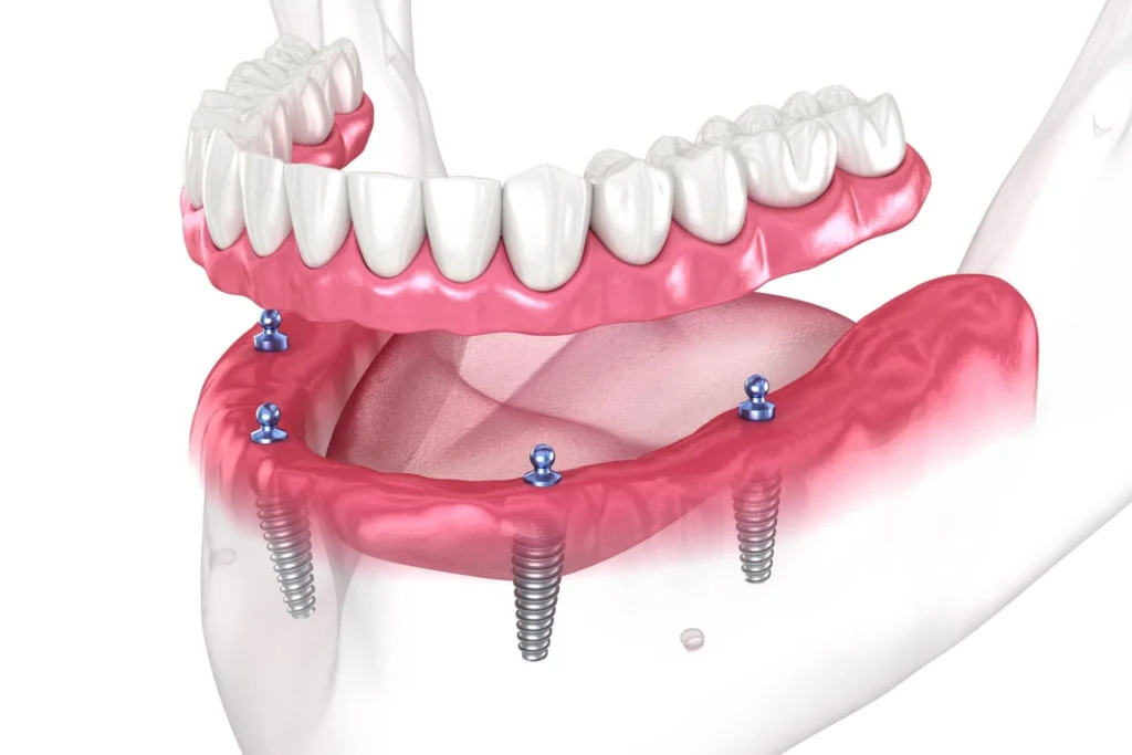 full dental implants, all on 4