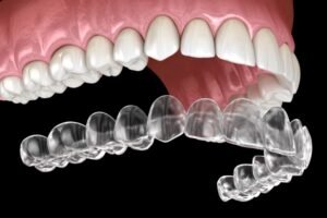 best clear aligners for teeth straightening for kids and adults in Algonquin IL