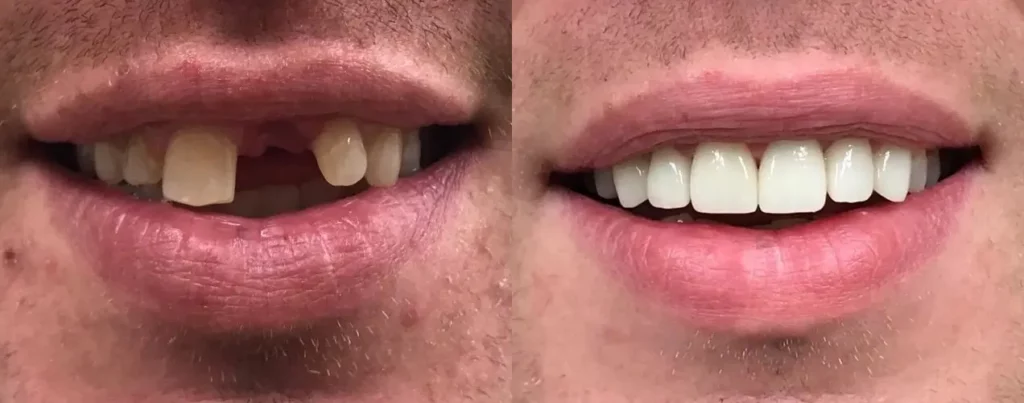 before and after tooth implants