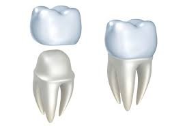 Dentist for Dental Crowns in Algonquin IL