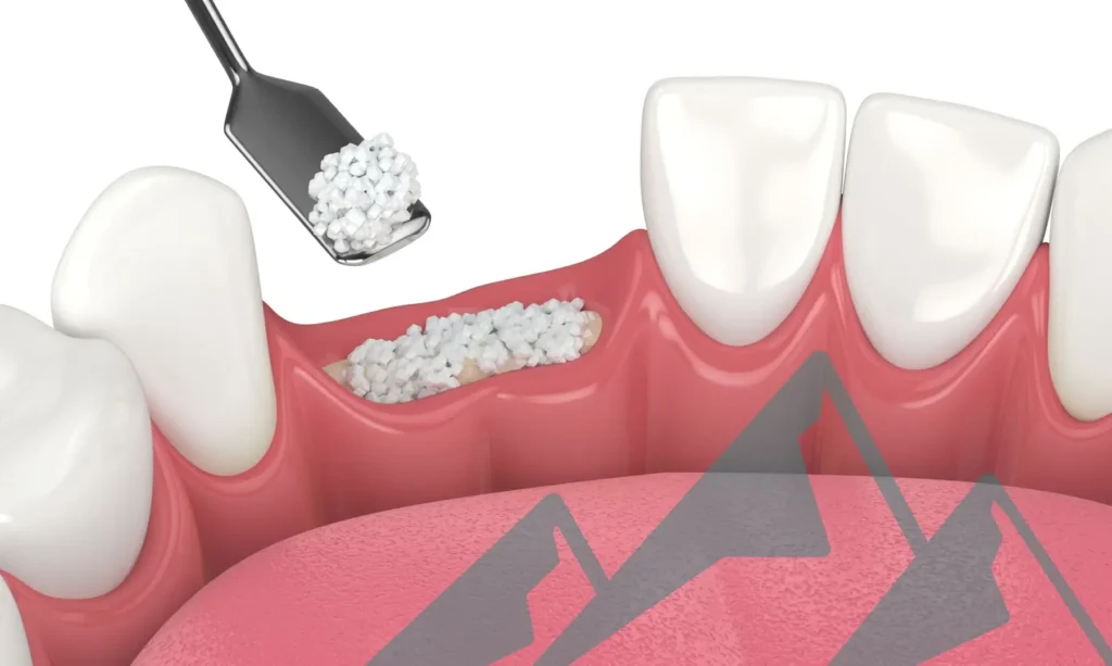 dental bone gtaft prodecure in Algonquuin, Illinois for missing teeth