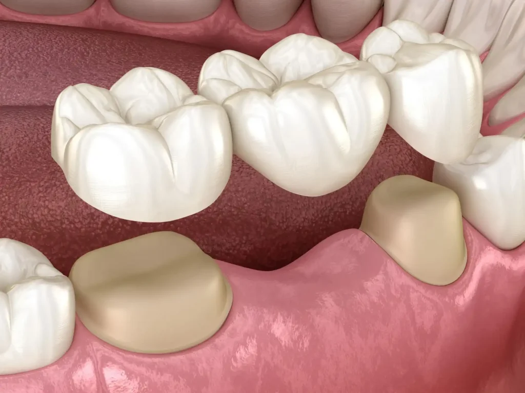 dental bridges specialist in Algonquin to restore smiles with durable, natural-looking teeth