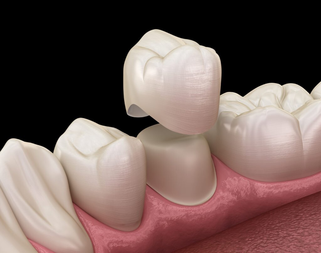bestsame day dental crowns for missing or damaaged teeth, tooth replacement in Algonquin, Il and nearby locations