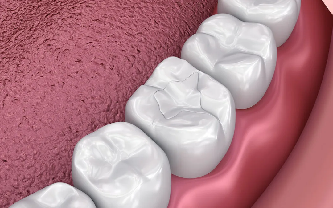 tooth filling and cavity filling by dentist in algonquuin Illinois