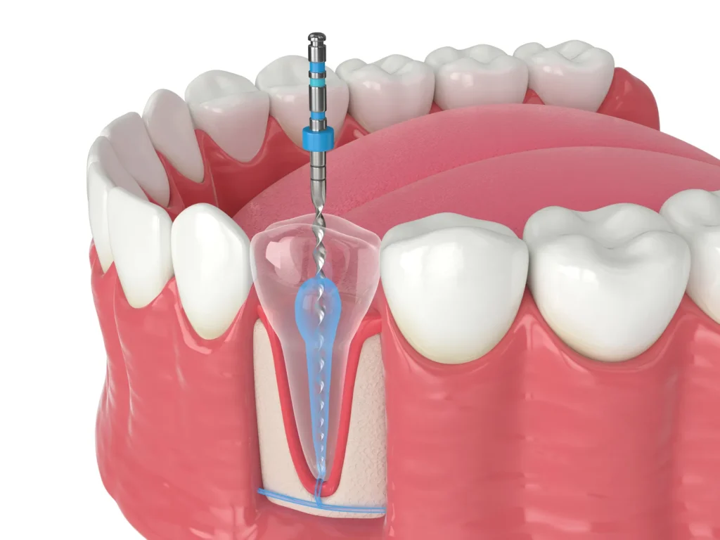endodontics performing root canal treatment to save from tooth decay, cracks, severe pain by removing damaged tissues and seals it to prevent further issues