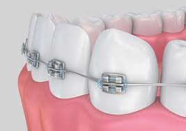 traditional braces for kids and teens in Algonquin IL