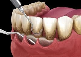 Expert periodontal treatment in Algonquin, IL at Dental Eclipse