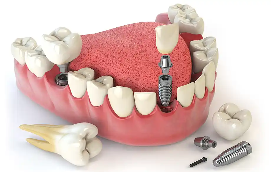 prosthodontics in Algonqin, IL at Dental Eclipse restore or replace damanged teeth or missing teeth