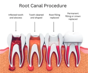 root canal treatment in Algonquin Illinois for cavities and severe toothache