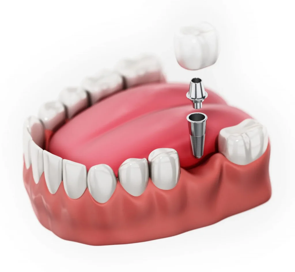 single tooth replacement process