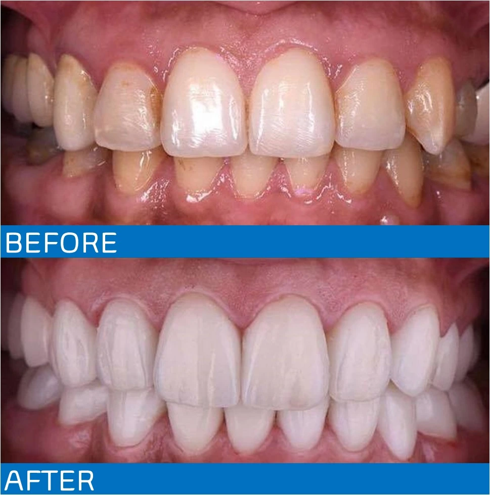 teeth cleaning after and before results