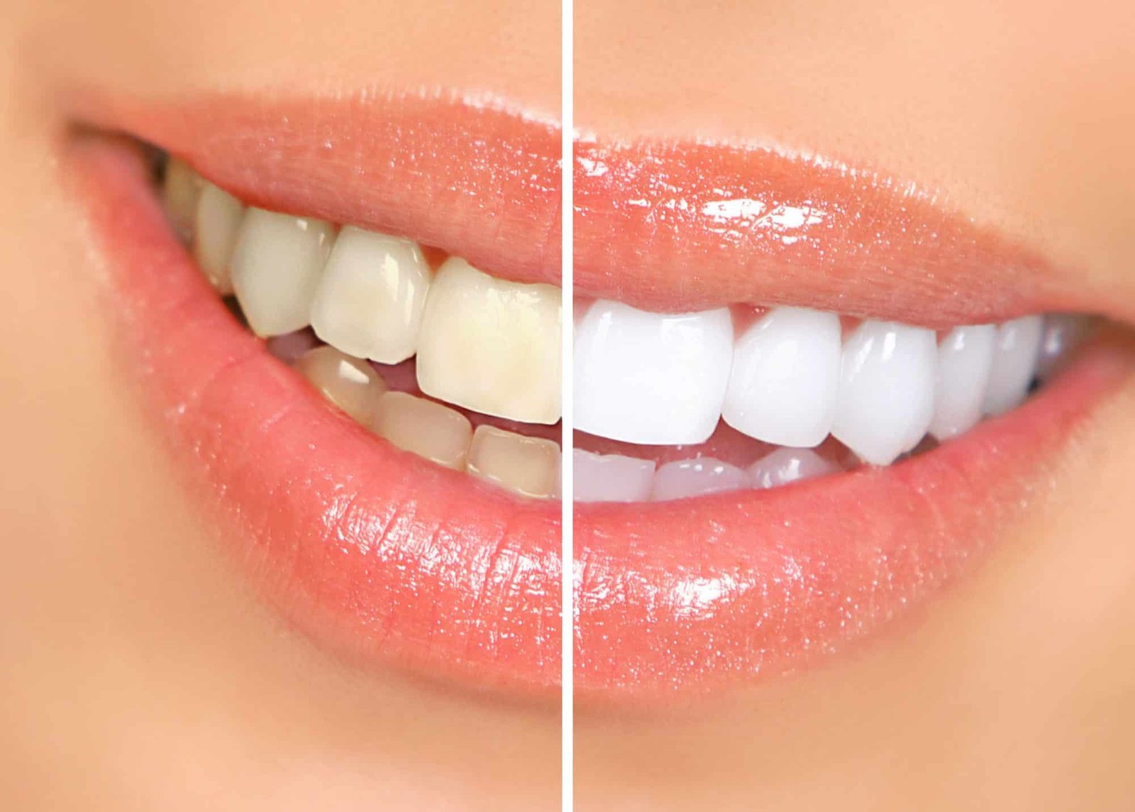 best professional teeth whitening dentist in algonqin IL making teeeth 5 times whiter than before