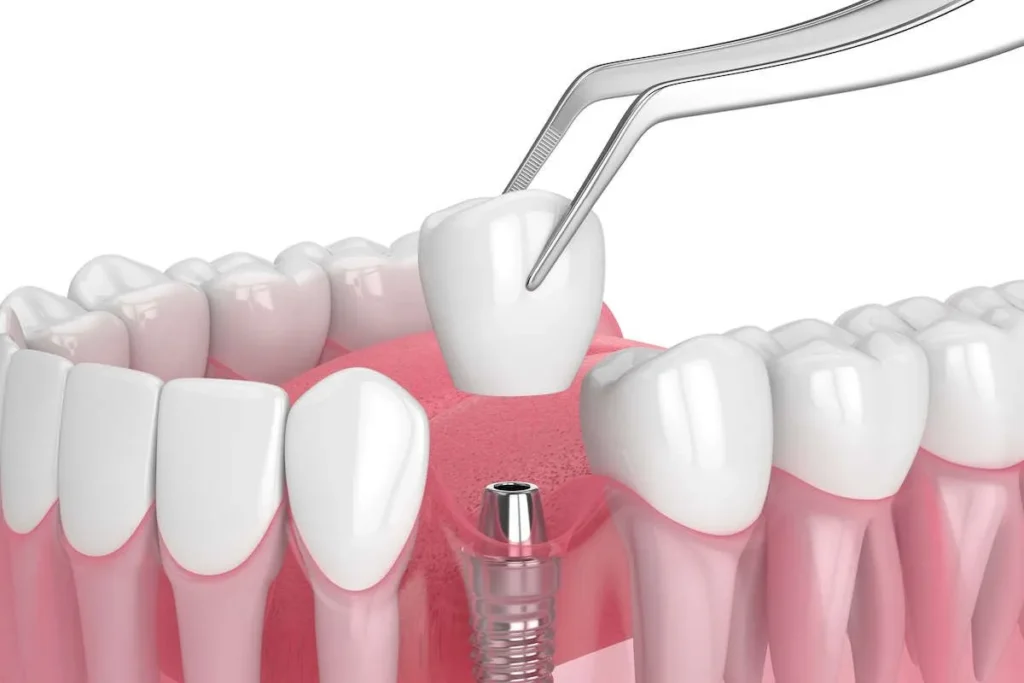 tooth replacement process at Dental Eclipse in Algonquin