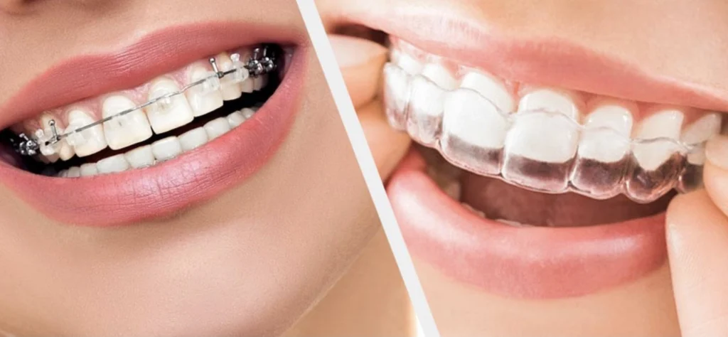 Invisalign and clear aligners in Algonquin, orthodontic consultation