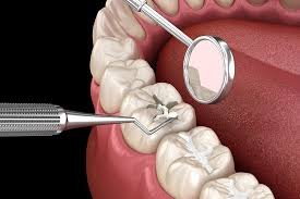 cavity treatment with dental sealant in Algonquin Illinois